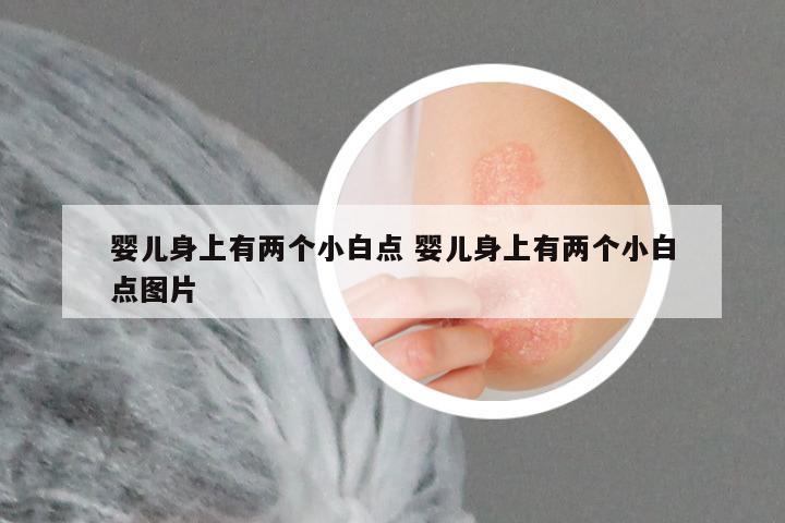 婴儿身上有两个小白点 婴儿身上有两个小白点图片