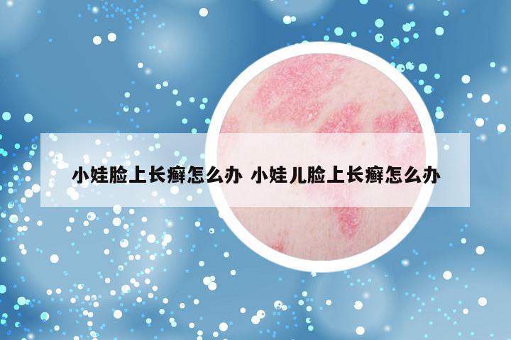 小娃脸上长癣怎么办 小娃儿脸上长癣怎么办