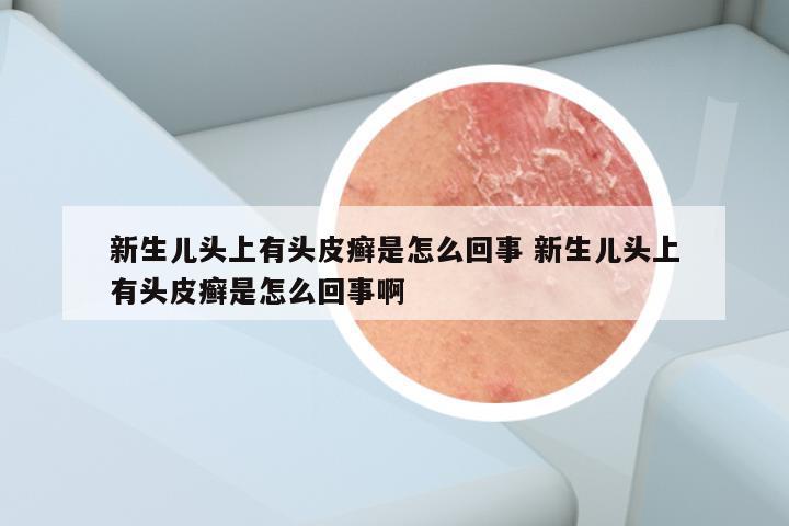 新生儿头上有头皮癣是怎么回事 新生儿头上有头皮癣是怎么回事啊