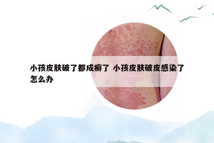 小孩皮肤破了都成癣了 小孩皮肤破皮感染了怎么办