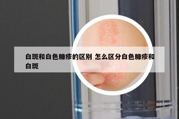 白斑和白色糠疹的区别 怎么区分白色糠疹和白斑