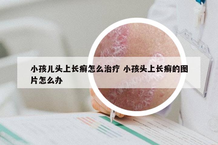 小孩儿头上长癣怎么治疗 小孩头上长癣的图片怎么办