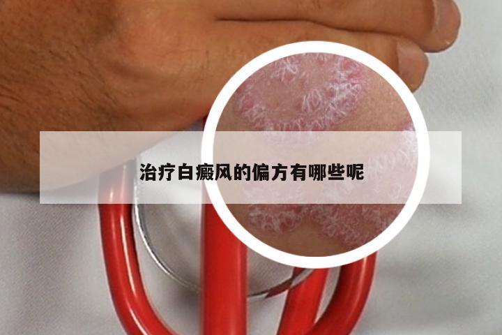 治疗白癜风的偏方有哪些呢