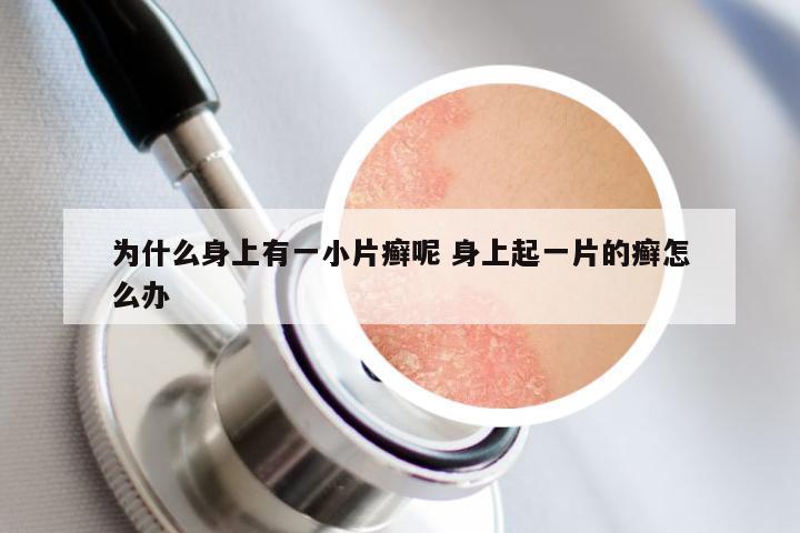 为什么身上有一小片癣呢 身上起一片的癣怎么办