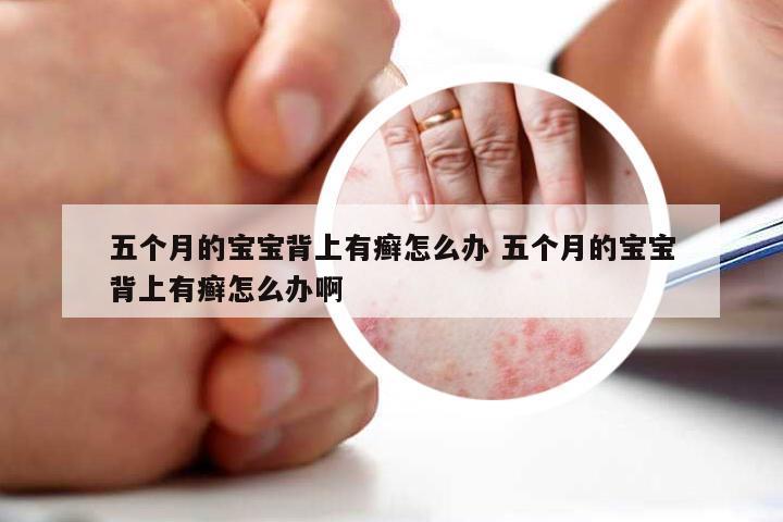 五个月的宝宝背上有癣怎么办 五个月的宝宝背上有癣怎么办啊
