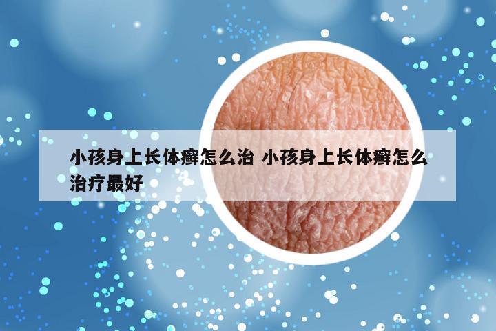 小孩身上长体癣怎么治 小孩身上长体癣怎么治疗最好