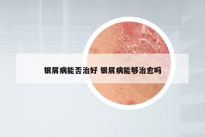银屑病能否治好 银屑病能够治愈吗