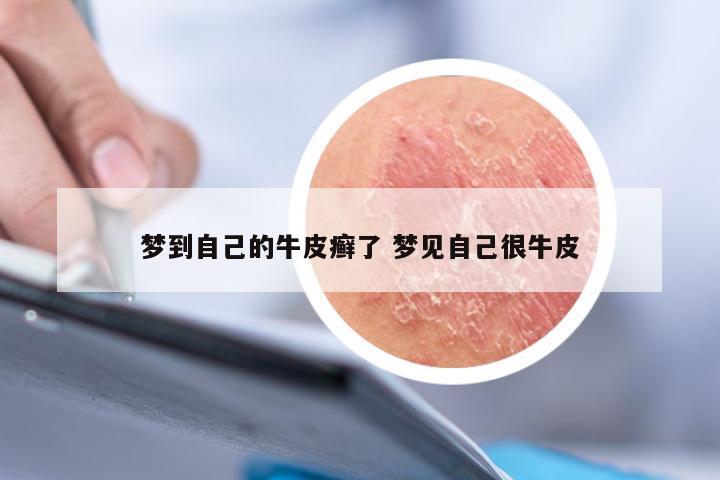 梦到自己的牛皮癣了 梦见自己很牛皮