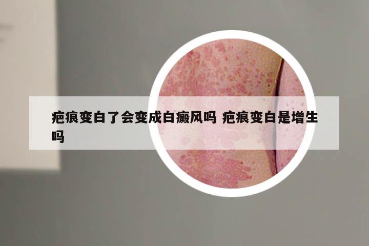 疤痕变白了会变成白癜风吗 疤痕变白是增生吗