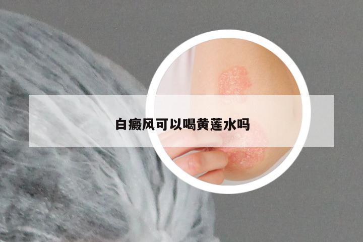 白癜风可以喝黄莲水吗
