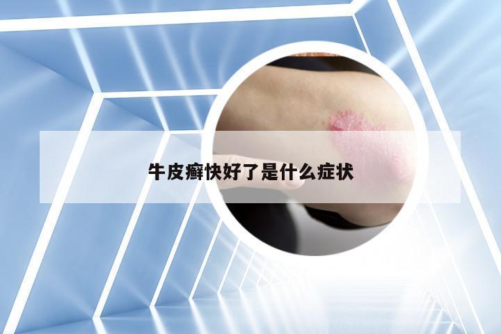 牛皮癣快好了是什么症状