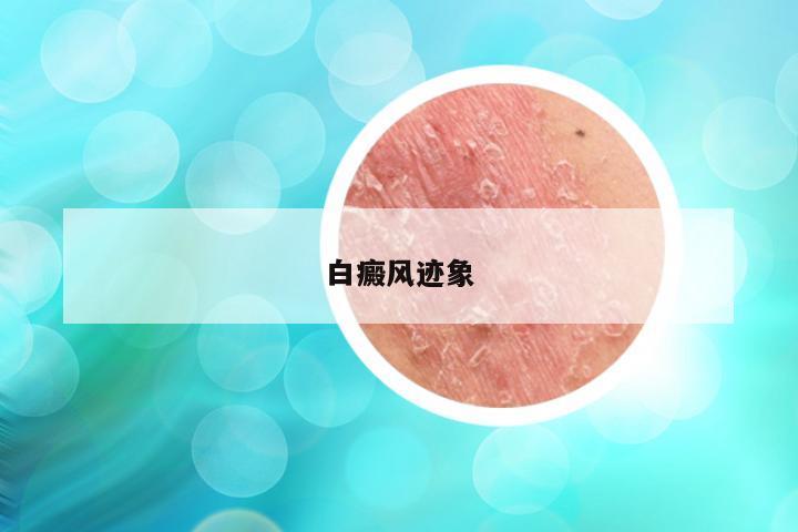 白癜风迹象