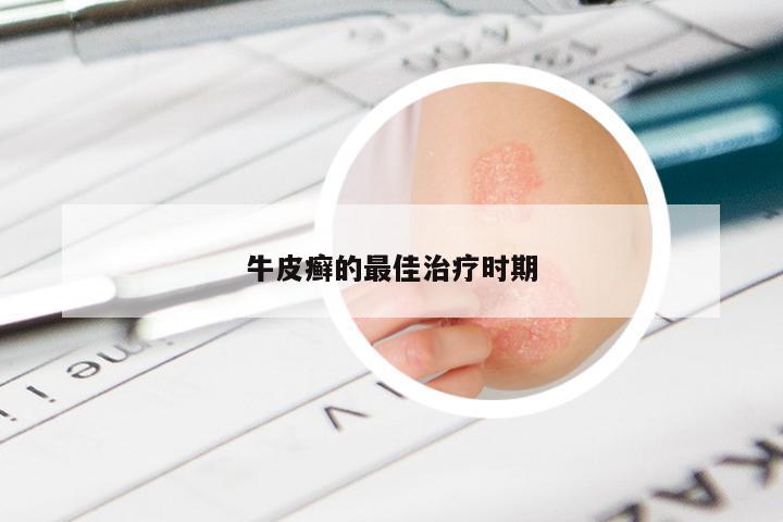 牛皮癣的最佳治疗时期