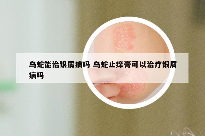 乌蛇能治银屑病吗 乌蛇止痒膏可以治疗银屑病吗
