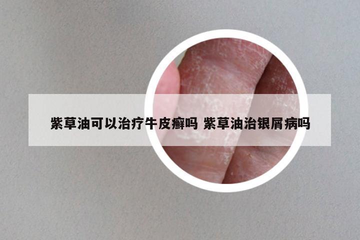 紫草油可以治疗牛皮癣吗 紫草油治银屑病吗