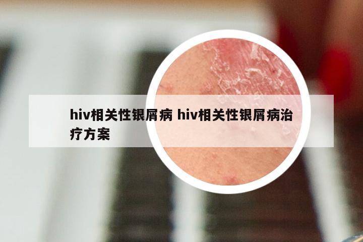 hiv相关性银屑病 hiv相关性银屑病治疗方案