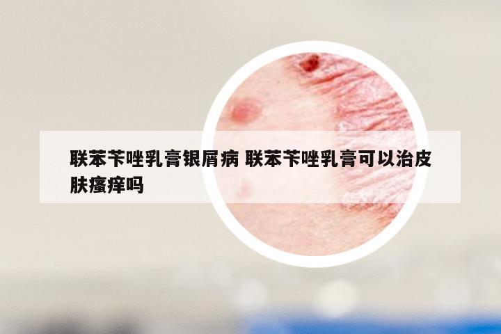联苯苄唑乳膏银屑病 联苯苄唑乳膏可以治皮肤瘙痒吗