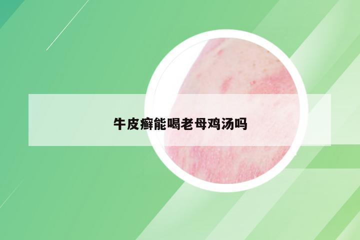 牛皮癣能喝老母鸡汤吗