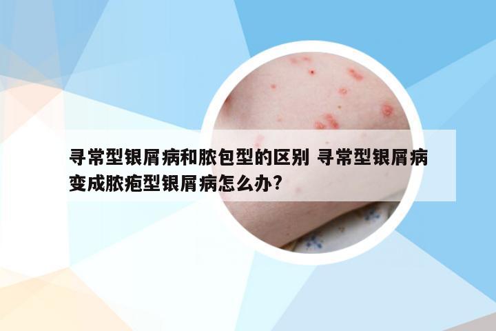 寻常型银屑病和脓包型的区别 寻常型银屑病变成脓疱型银屑病怎么办?