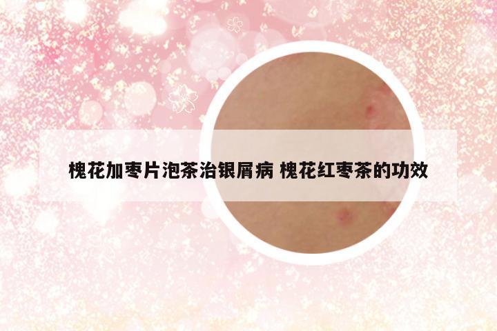 槐花加枣片泡茶治银屑病 槐花红枣茶的功效