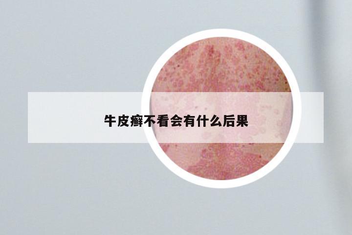 牛皮癣不看会有什么后果