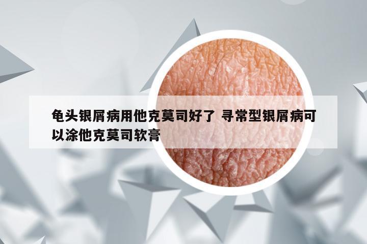 龟头银屑病用他克莫司好了 寻常型银屑病可以涂他克莫司软膏