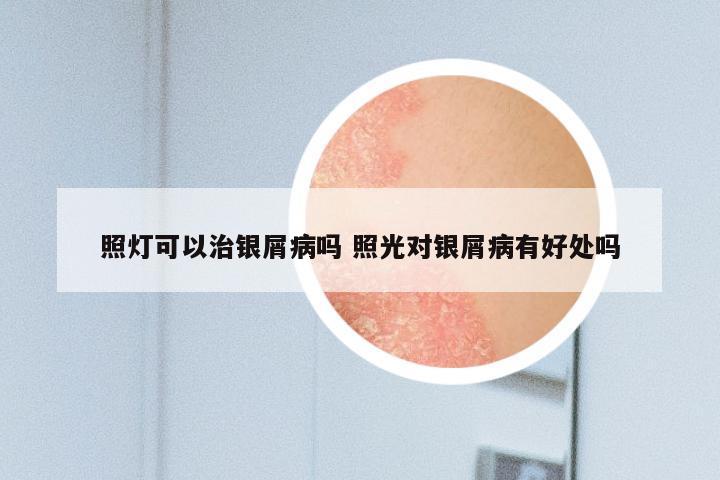 照灯可以治银屑病吗 照光对银屑病有好处吗