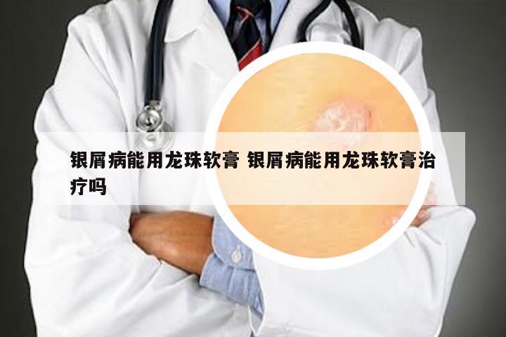银屑病能用龙珠软膏 银屑病能用龙珠软膏治疗吗