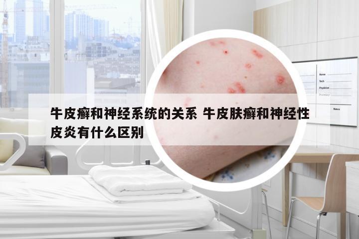 牛皮癣和神经系统的关系 牛皮肤癣和神经性皮炎有什么区别
