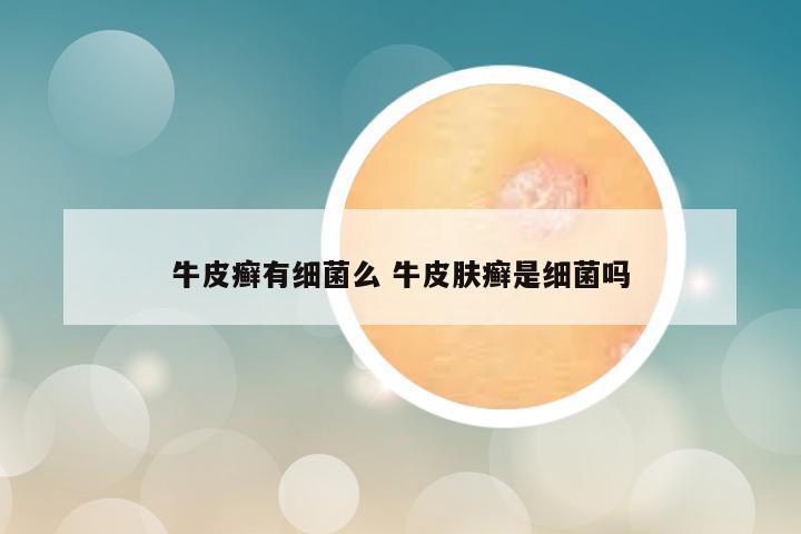 牛皮癣有细菌么 牛皮肤癣是细菌吗