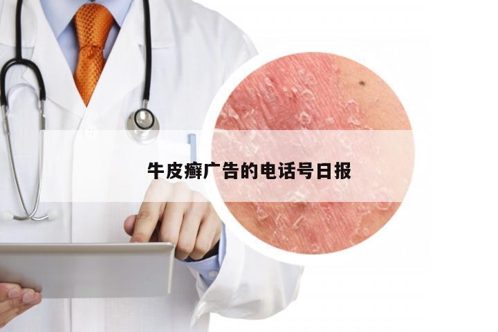 牛皮癣广告的电话号日报