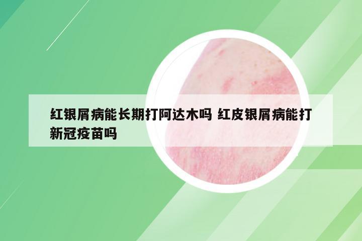红银屑病能长期打阿达木吗 红皮银屑病能打新冠疫苗吗
