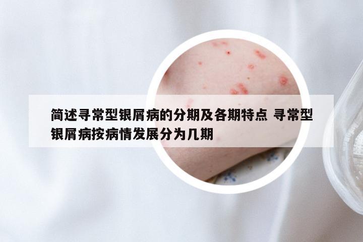 简述寻常型银屑病的分期及各期特点 寻常型银屑病按病情发展分为几期