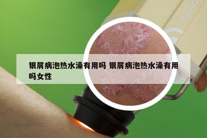 银屑病泡热水澡有用吗 银屑病泡热水澡有用吗女性