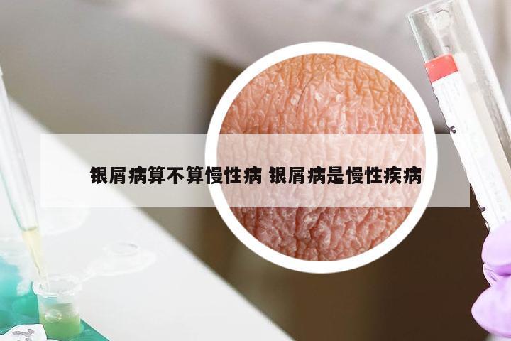 银屑病算不算慢性病 银屑病是慢性疾病