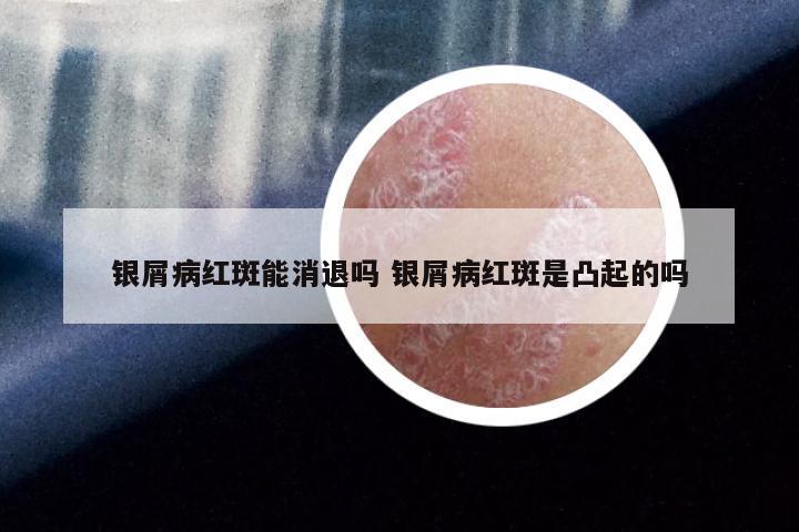 银屑病红斑能消退吗 银屑病红斑是凸起的吗