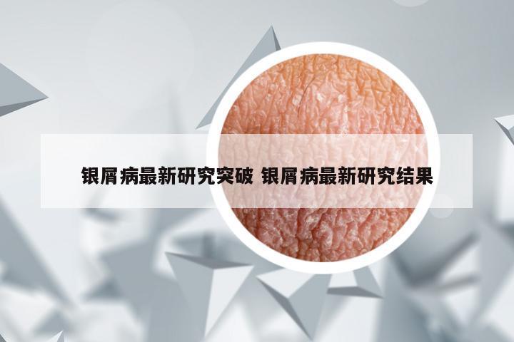 银屑病最新研究突破 银屑病最新研究结果