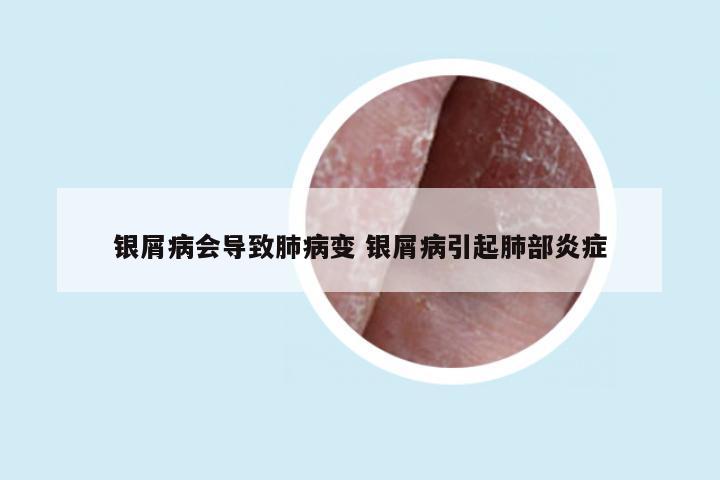 银屑病会导致肺病变 银屑病引起肺部炎症