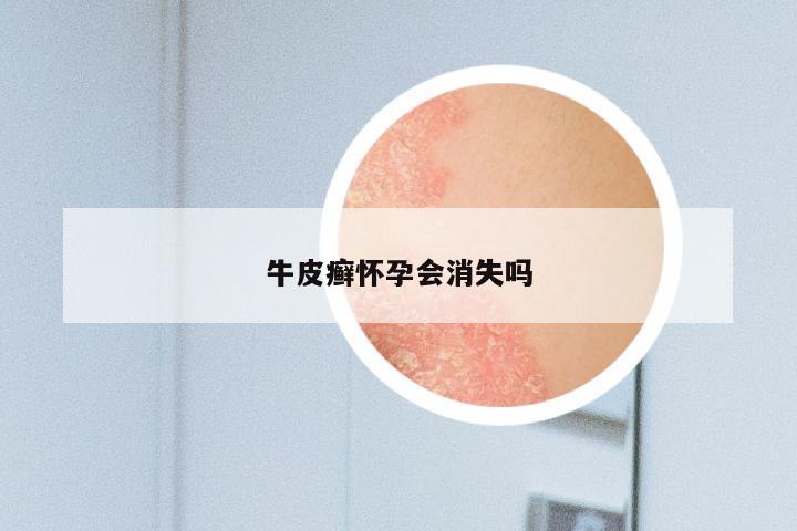 牛皮癣怀孕会消失吗