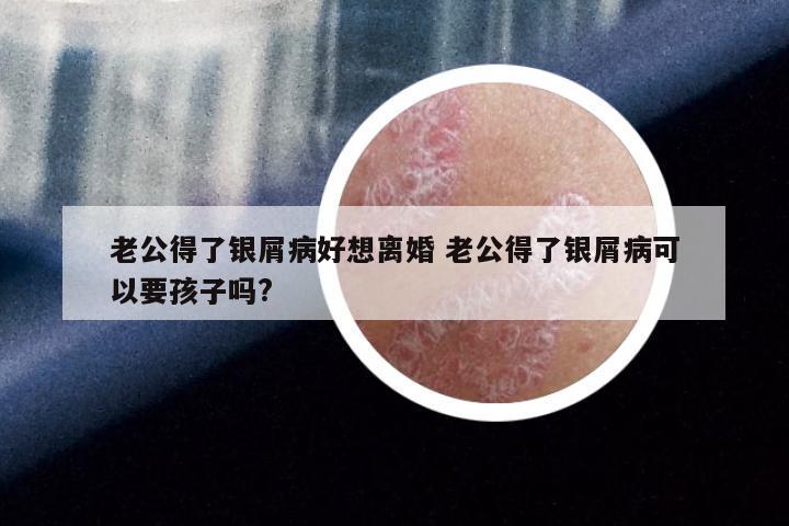 老公得了银屑病好想离婚 老公得了银屑病可以要孩子吗?