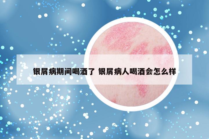 银屑病期间喝酒了 银屑病人喝酒会怎么样