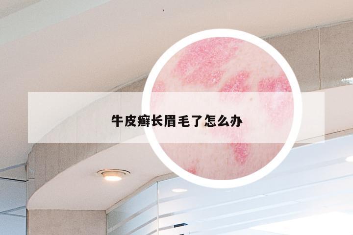 牛皮癣长眉毛了怎么办