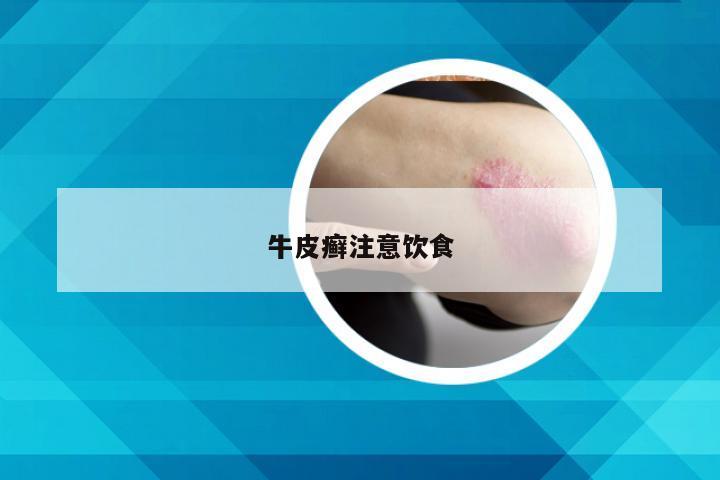 牛皮癣注意饮食