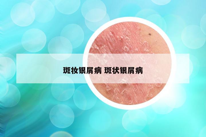 斑妆银屑病 斑状银屑病