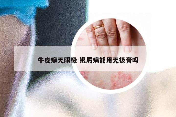 牛皮癣无限极 银屑病能用无极膏吗