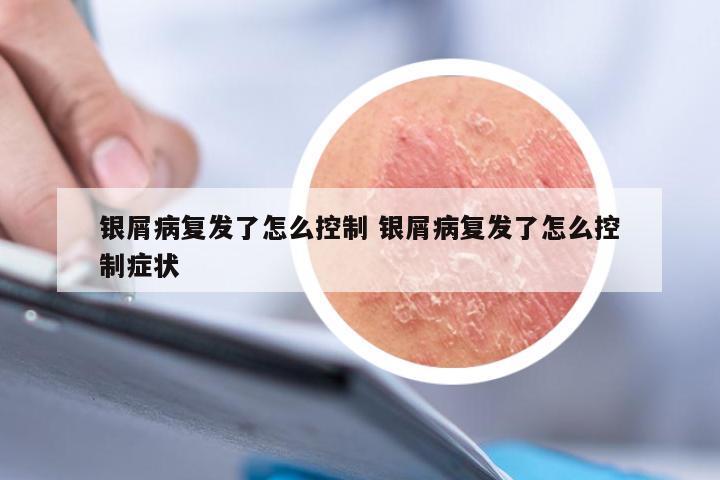 银屑病复发了怎么控制 银屑病复发了怎么控制症状