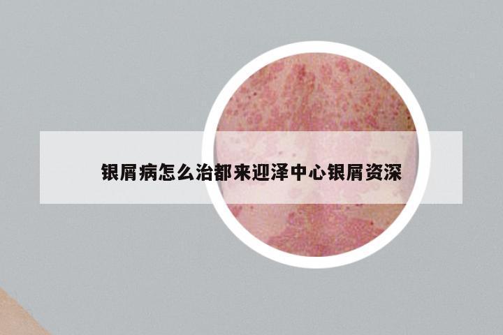 银屑病怎么治都来迎泽中心银屑资深