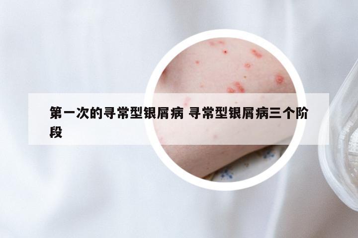 第一次的寻常型银屑病 寻常型银屑病三个阶段