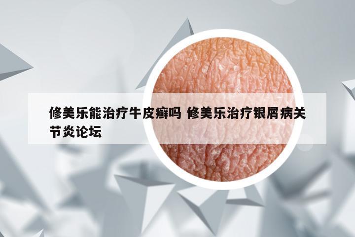 修美乐能治疗牛皮癣吗 修美乐治疗银屑病关节炎论坛