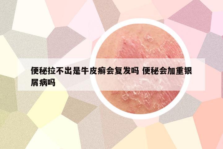 便秘拉不出是牛皮癣会复发吗 便秘会加重银屑病吗